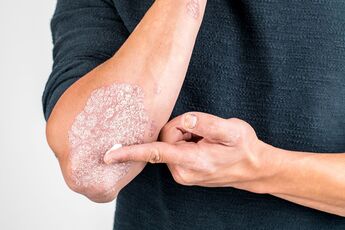 Aplicarea cremei pe zona pielii deteriorată de psoriazis