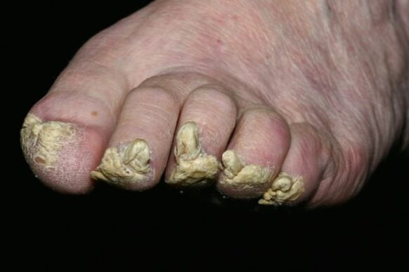 psoriazisul unghiilor de la picioare