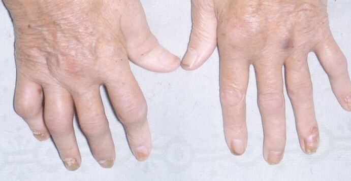 psoriazis artropatic pe maini