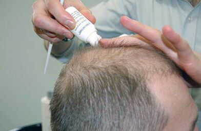 tratamentul psoriazisului scalpului