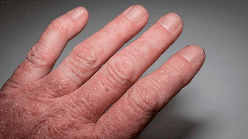 artrita psoriazica pe maini
