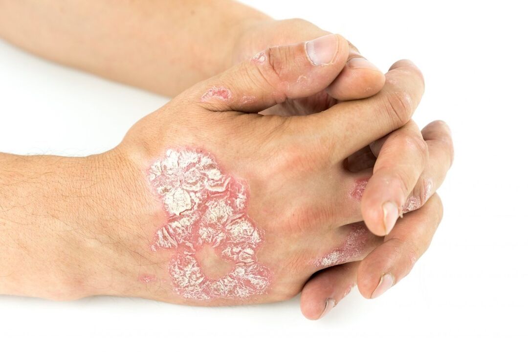 cum arată psoriazisul pe mâini
