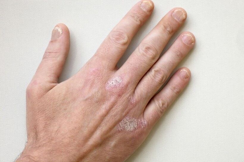 Un simptom obligatoriu al psoriazisului sunt plăcile cu solzi pe piele