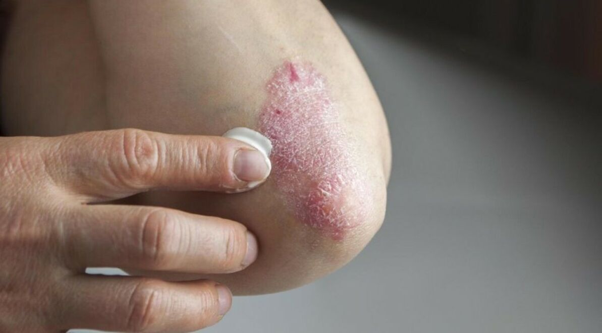 Psoriazisul care afectează pielea, al cărui tratament include utilizarea de unguente