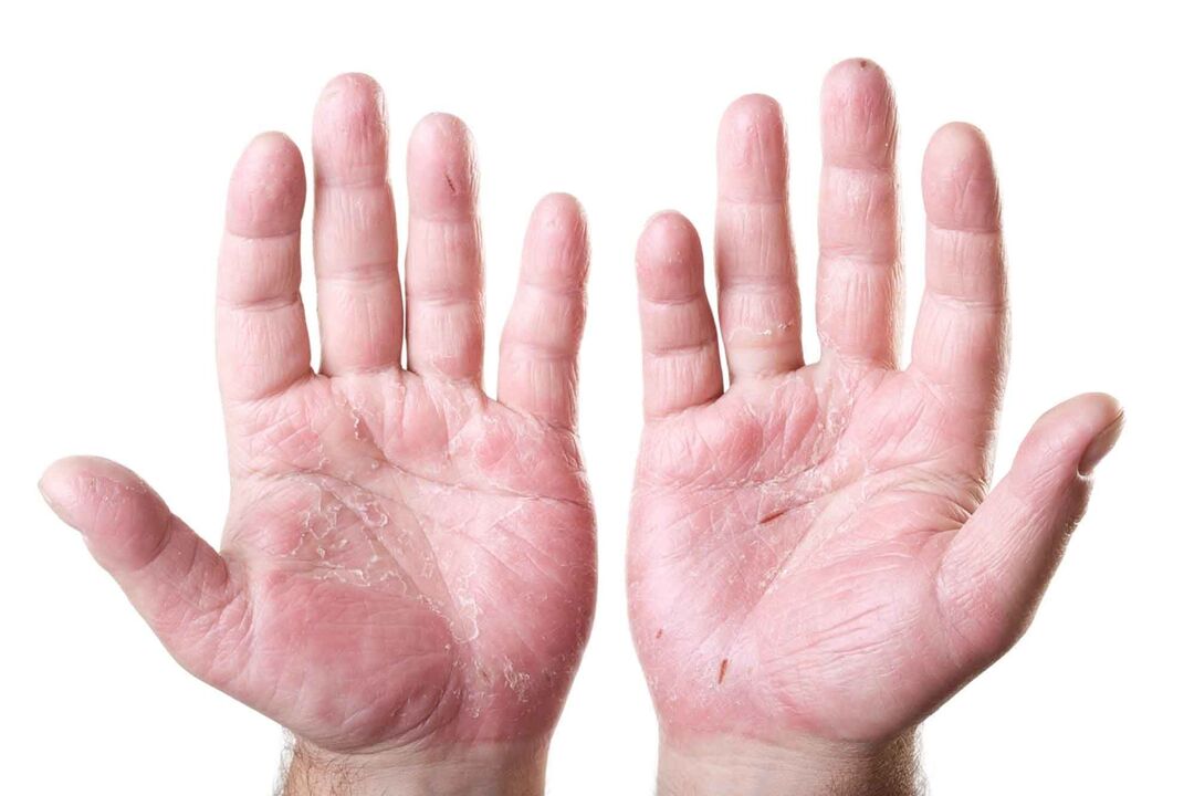 tipuri de psoriazis pe palme