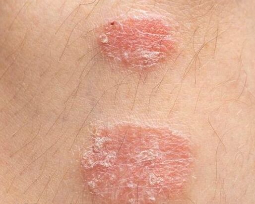Apariția plăcilor psoriazice