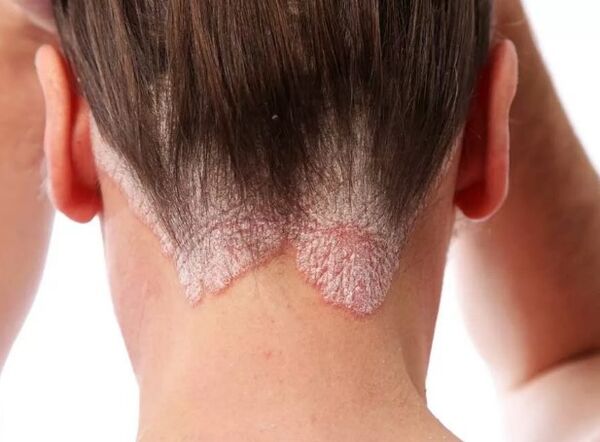 Eritroderma psoriazică