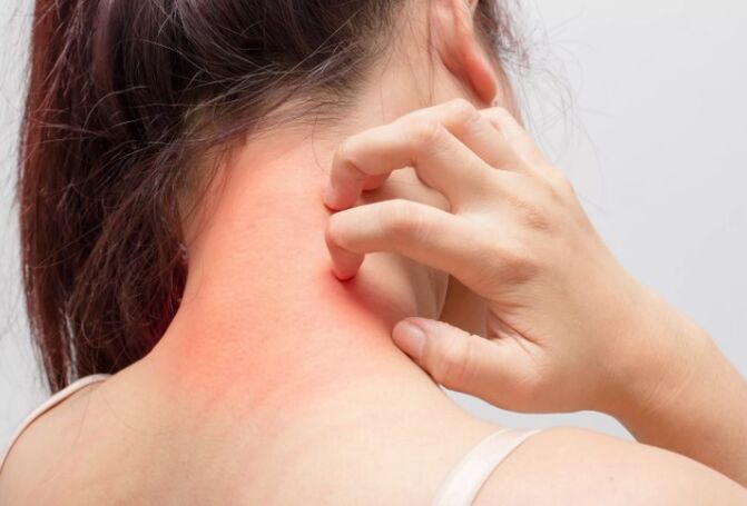 Mâncărimea este una dintre cauzele psoriazisului
