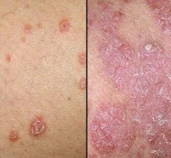 Plăci psoriazice