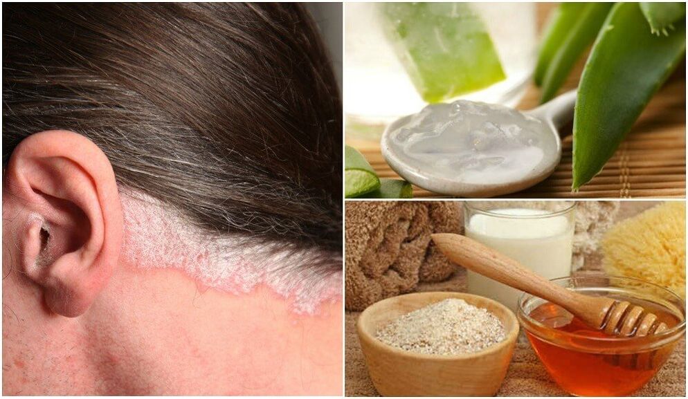 Tratamentul psoriazisului cu remedii populare
