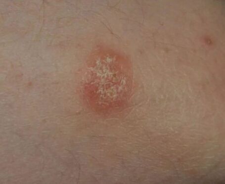 Loc psoriazis