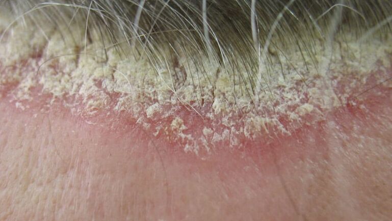 Psoriazisul scalpului