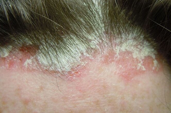 Psoriazisul surprinde întreaga parte păroasă a capului