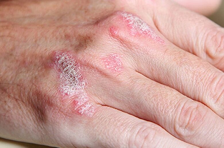 Psoriazisul susținut de ladomary