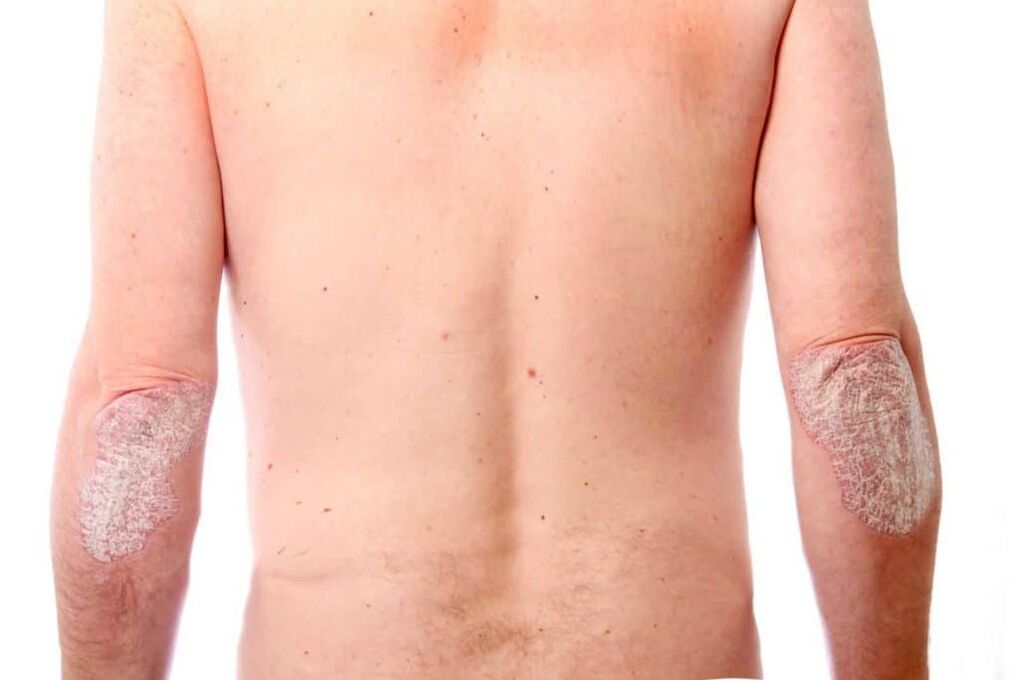 A doua etapă a psoriazisului