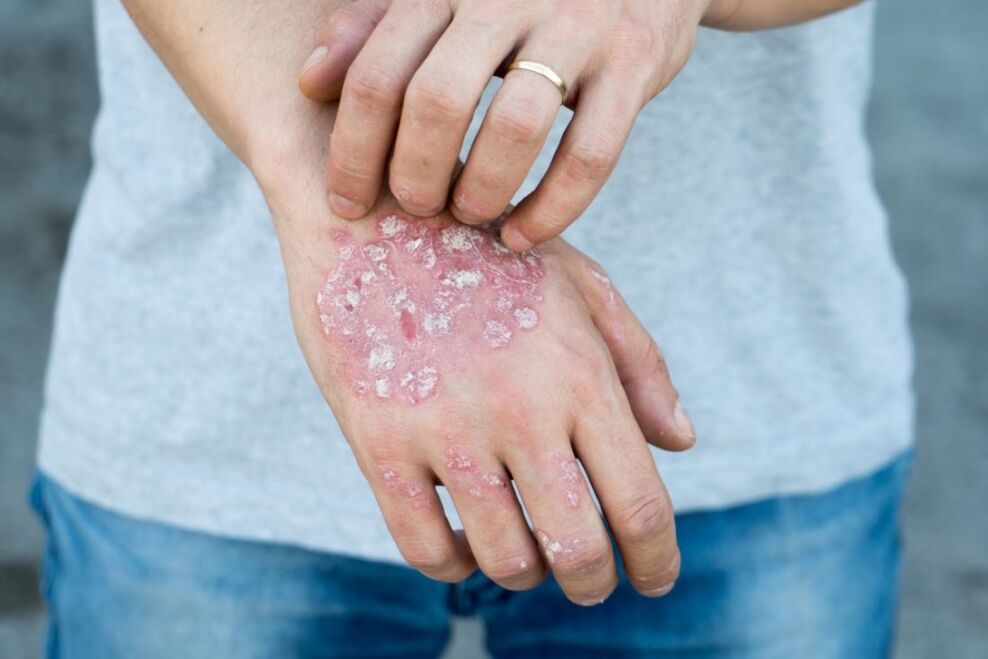 Psoriazisul este