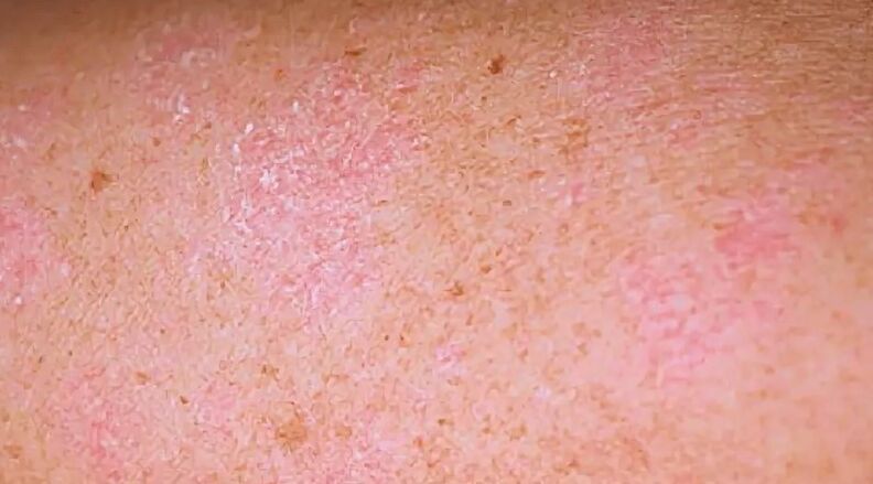 Etapa regresivă a psoriazisului