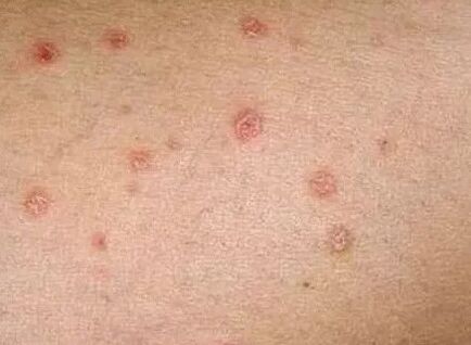 Psoriazisul etapei inițiale