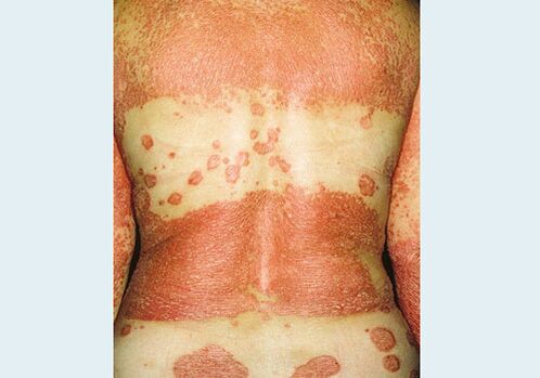 Psoriazis genital