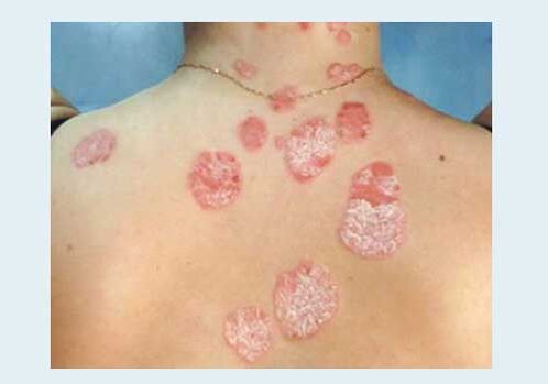 Psoriazisul obișnuit