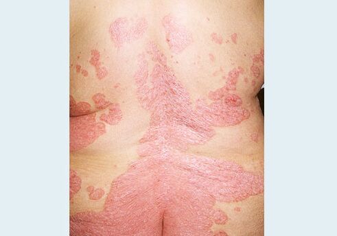 Psoriazisul spatelui
