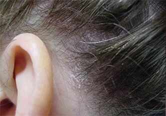 Psoriazis pe cap