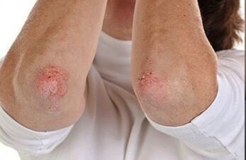 Psoriazis pe coate