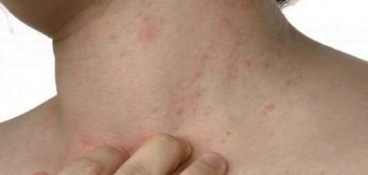 Psoriazis pe gât