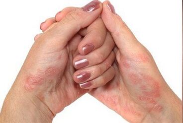 Psoriazis în mâini