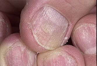 Psoriazisul unghiilor