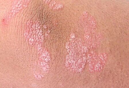 psoriazis