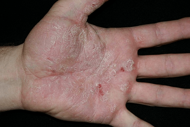Psoriazis în mâini
