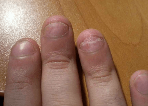 Psoriazisul unghiilor