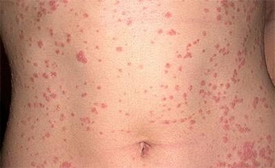 Psoriazis pe corp