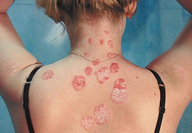 Psoriazis pe spate