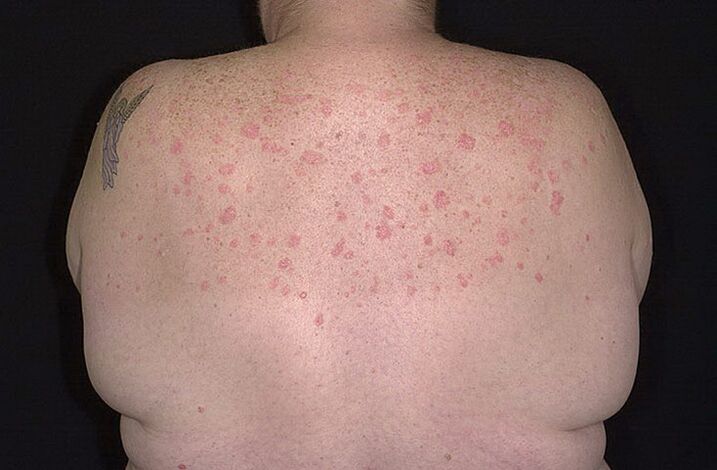 Psoriazis pe umeri