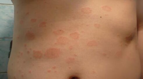 Psoriazisul etapei inițiale