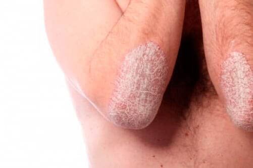 Psoriazisul pe coate