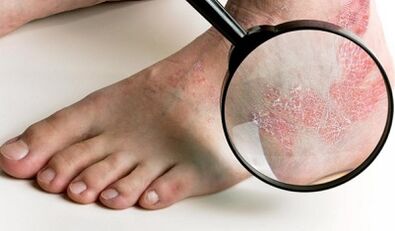 Opțiuni de tratament pentru psoriazis