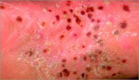 Psoriazisul pustular