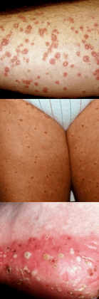 Psoriazis pe picioare