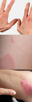 Psoriazisul etapei inițiale pe mâini