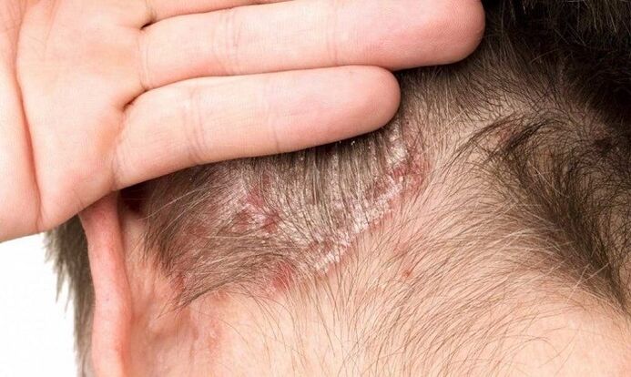 psoriazis pe cap