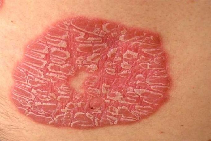 psoriazis pustular