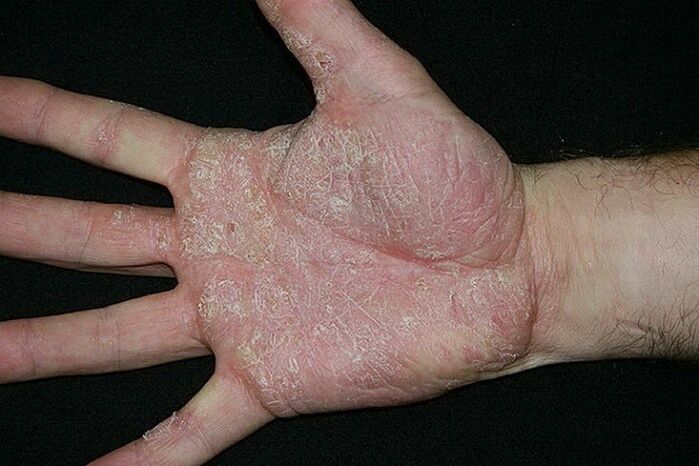psoriazisul palmelor și picioarelor