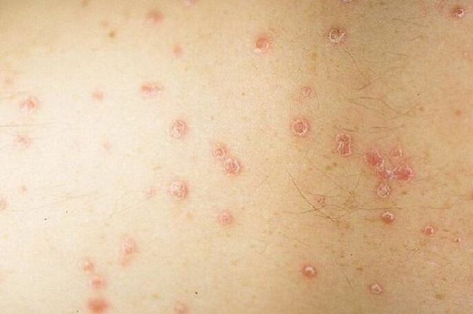 simptome de psoriazis local
