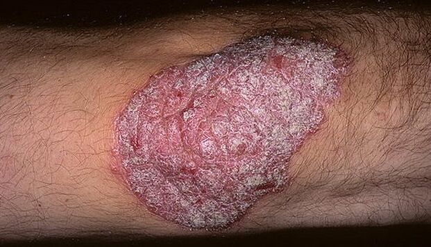 psoriazis