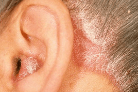 cauzele psoriazisului