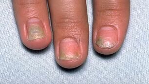 cauzele psoriazisului pe unghii